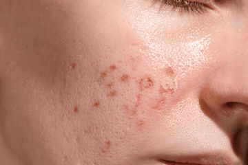 Is Clean Beauty Better for Sensitive Skin?